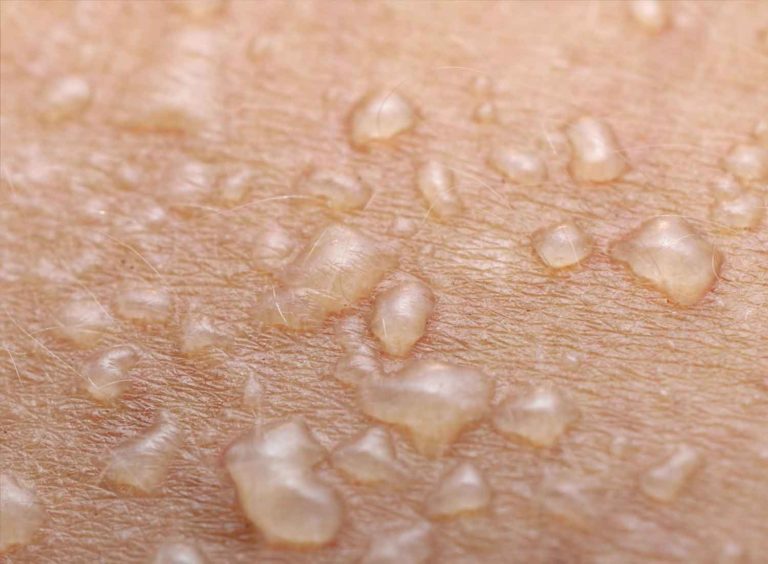 Recent Reports Discuss Cannabinoid Benefits for Blistering Skin Condition